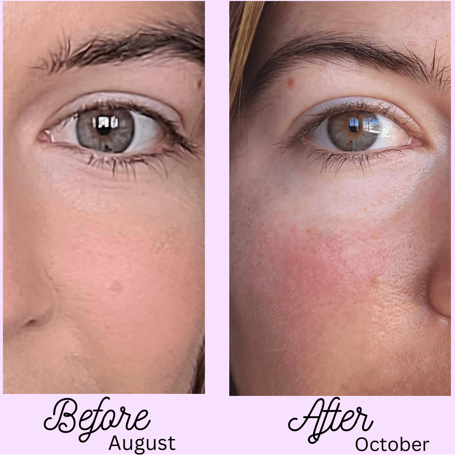 Exfoliating Cloth and Cleanser Sample Set before and after eye smile lines example