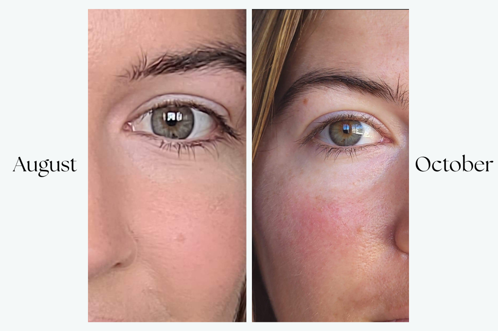 Two separate before and after images of the same eye, the left showing more prominent smile lines and the right showing smooth skin. The left is labeled August and the right is labeled October. 